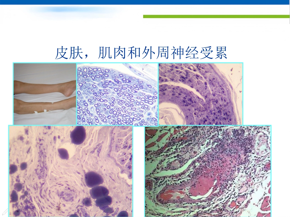 ANCA相关性小血管炎的诊治_第8页