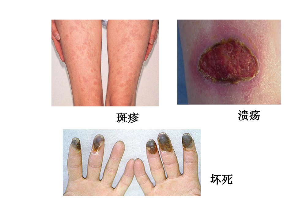 ANCA相关性小血管炎(2)_第11页