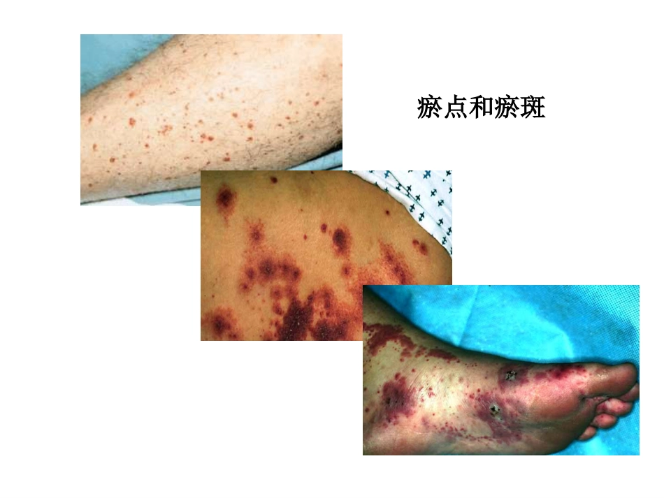 ANCA相关性小血管炎(2)_第12页