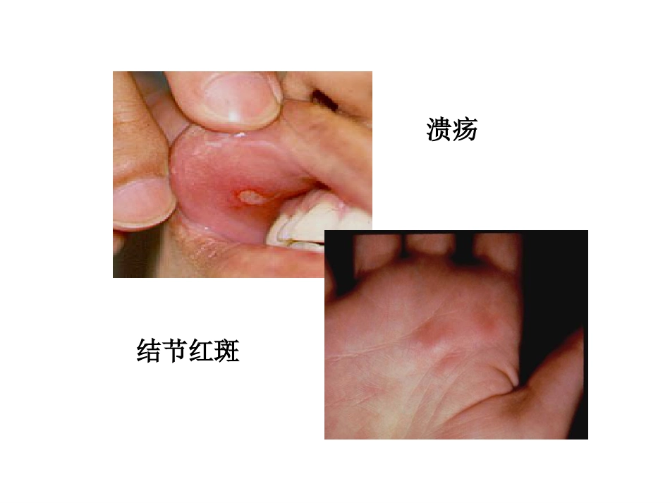 ANCA相关性小血管炎(2)_第13页