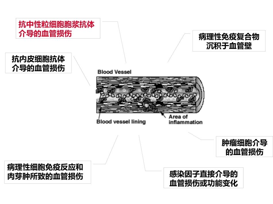 ANCA相关性小血管炎(2)_第6页