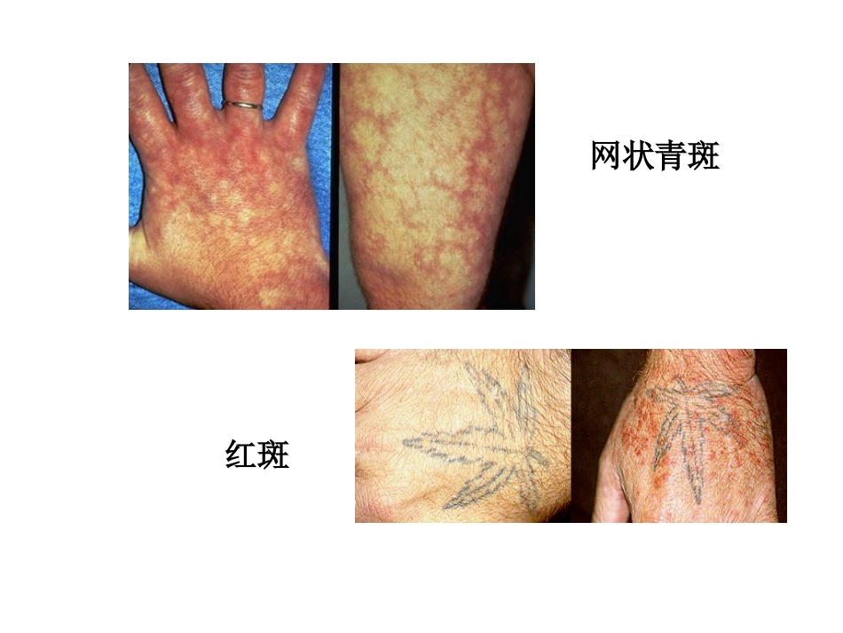 ANCA相关性小血管炎(2)_第9页