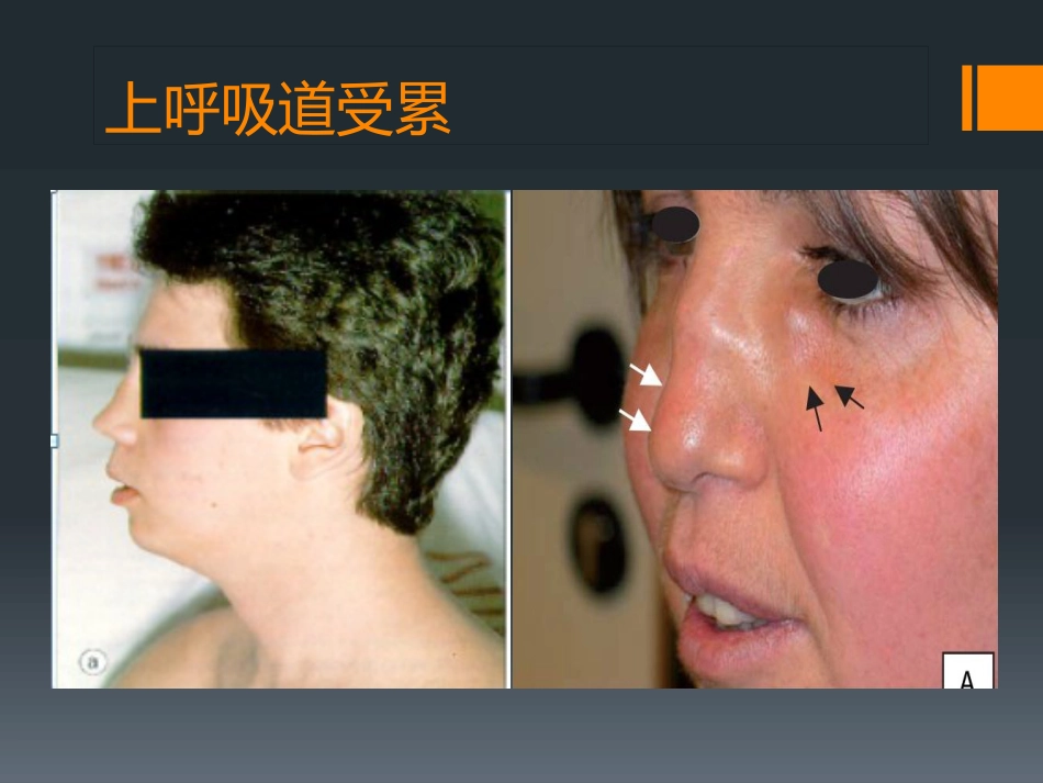 ANCA相关性小血管炎(1)_第12页