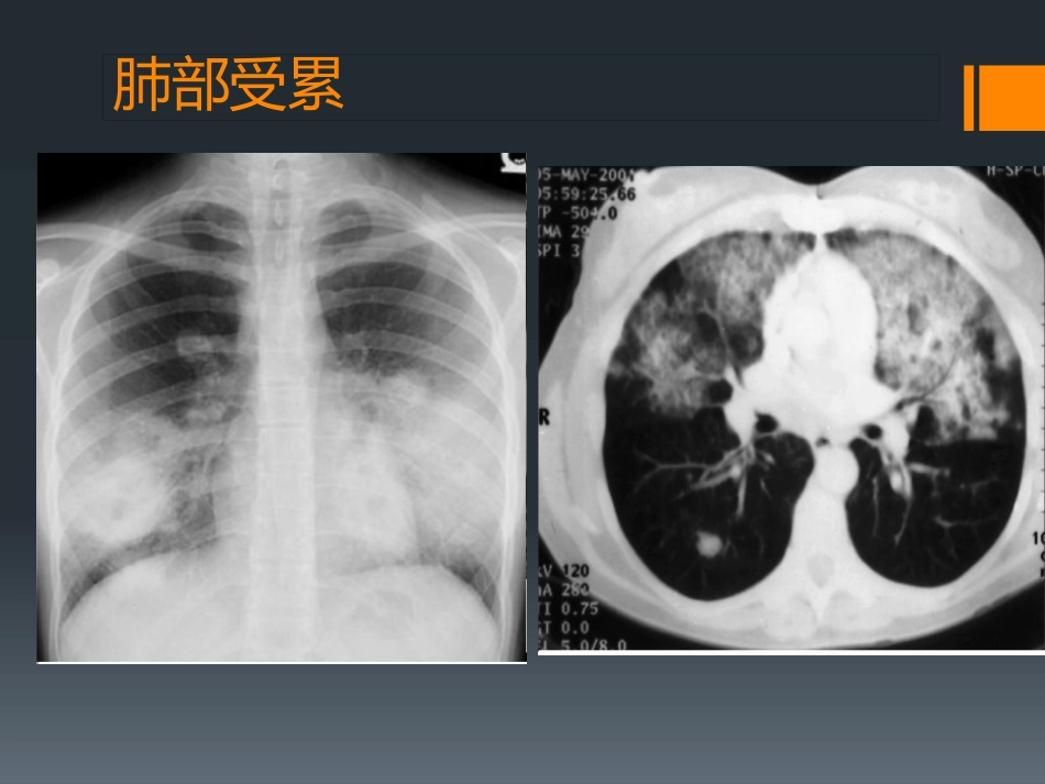 ANCA相关性小血管炎(1)_第14页