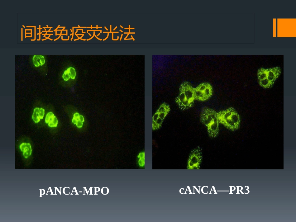 ANCA相关性小血管炎(1)_第7页