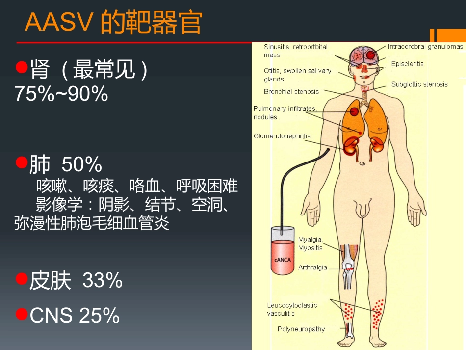 ANCA相关性小血管炎(1)_第8页