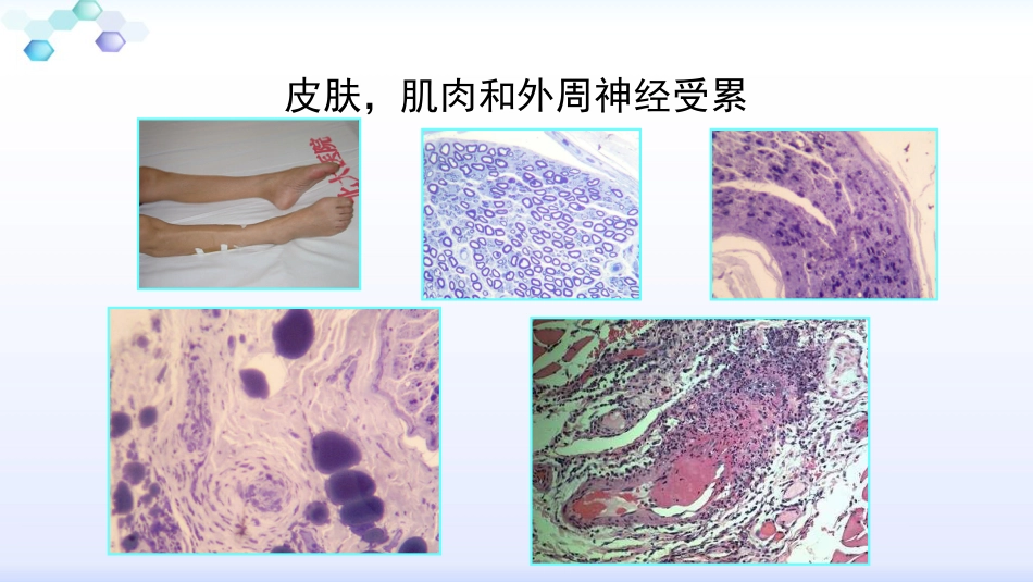 anca相关小血管炎的诊治_第12页