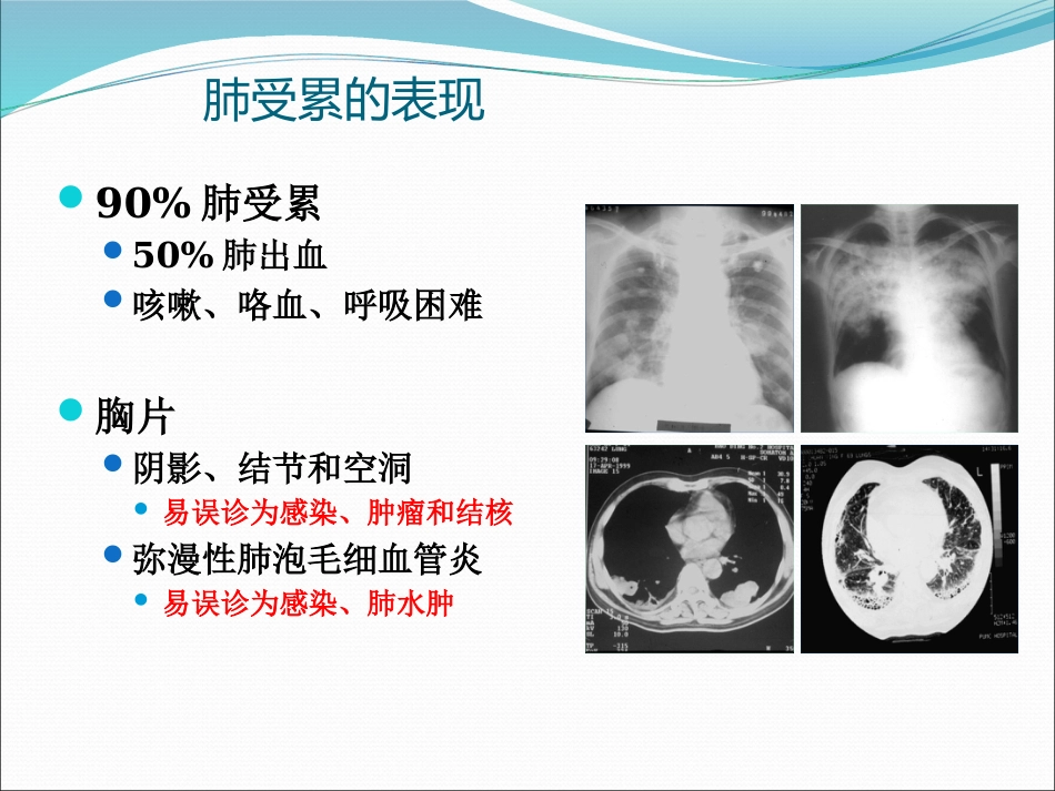 ANCA相关小血管炎的诊断和治疗_第12页