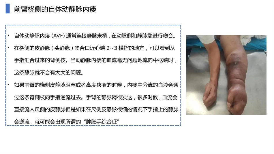 动静脉内瘘血管解剖及穿刺技巧_第11页