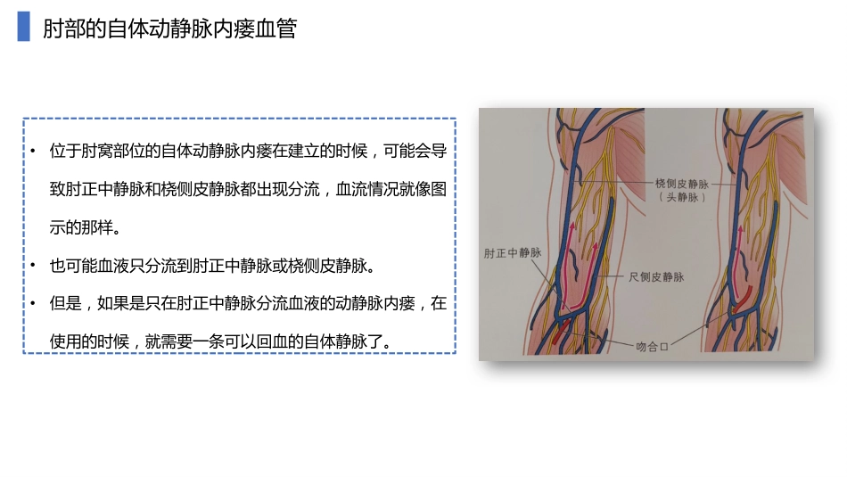 动静脉内瘘血管解剖及穿刺技巧_第15页