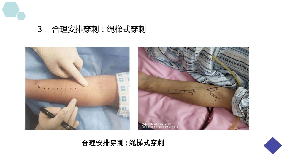 动静脉内瘘穿刺及维护_第10页