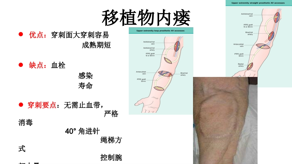 动静脉内瘘穿刺及维护_第14页