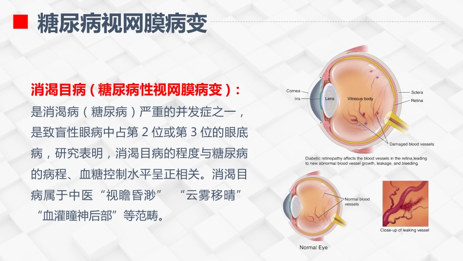 糖尿病视网膜病变患者护理查房_第4页