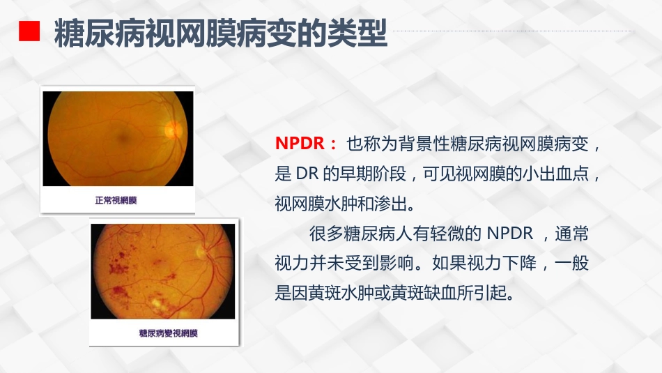 糖尿病视网膜病变患者护理查房_第8页