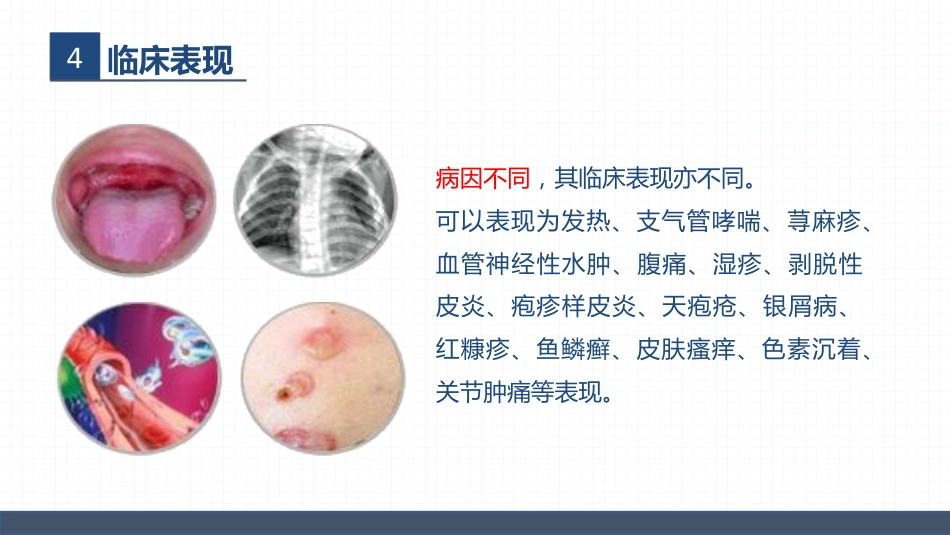 血液内科-嗜酸细胞增多症的护理查房_第11页