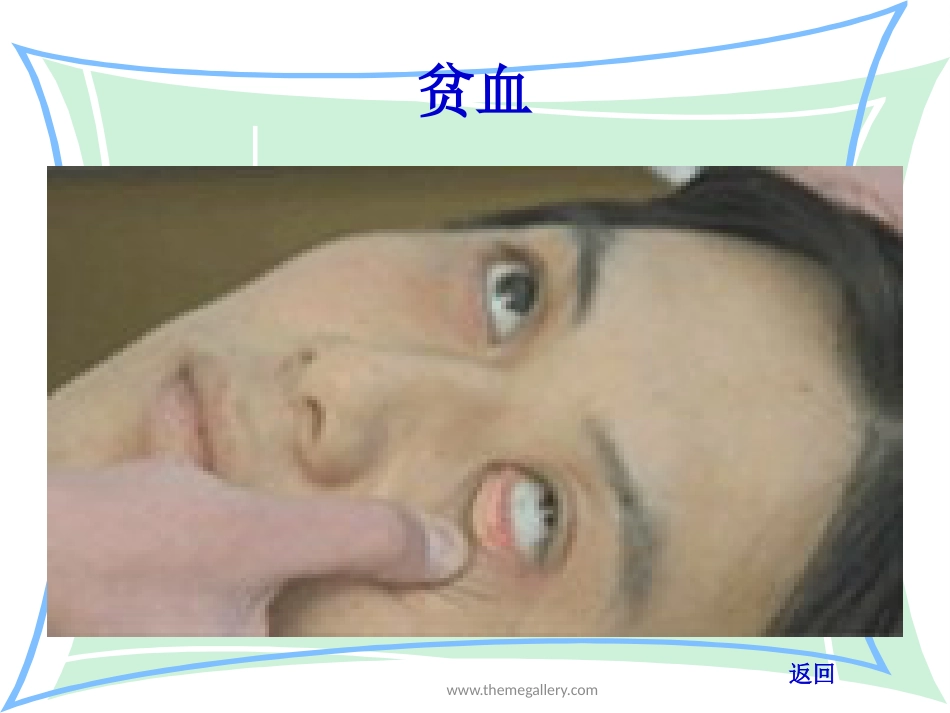 急性白血病的护理查房_第13页