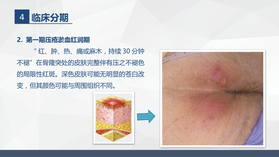 压疮的护理_第11页