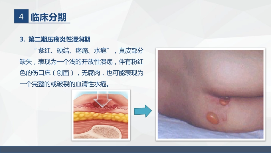 压疮的护理_第12页