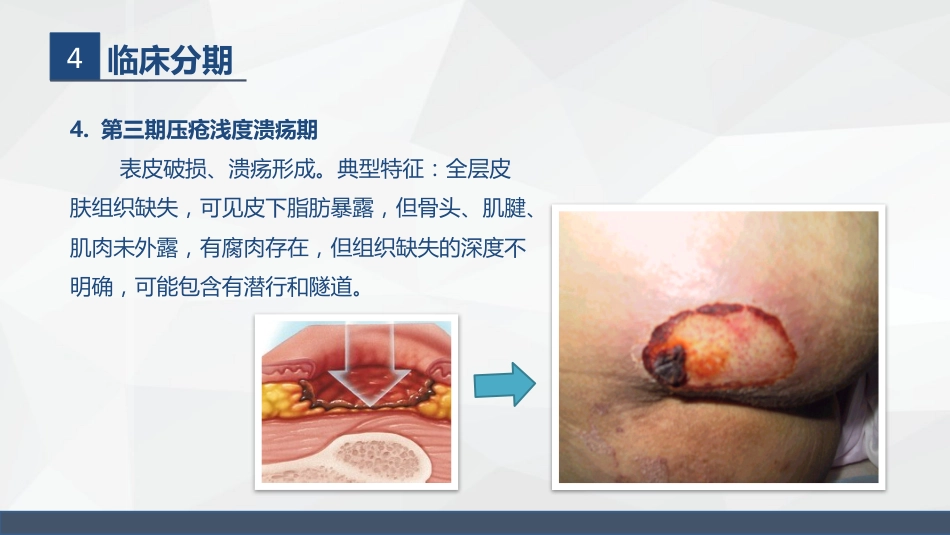 压疮的护理_第13页