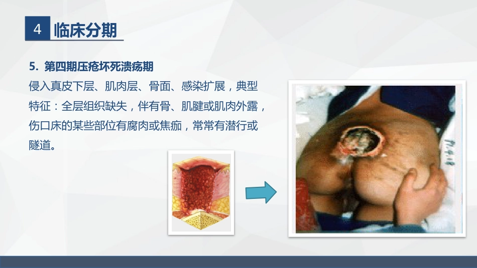 压疮的护理_第14页
