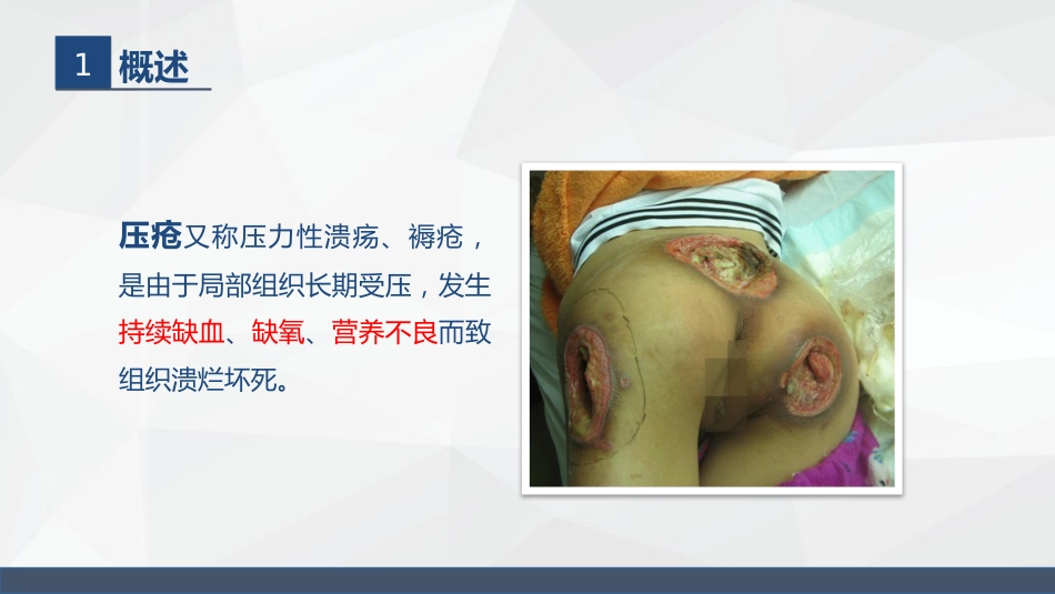 压疮的护理_第4页