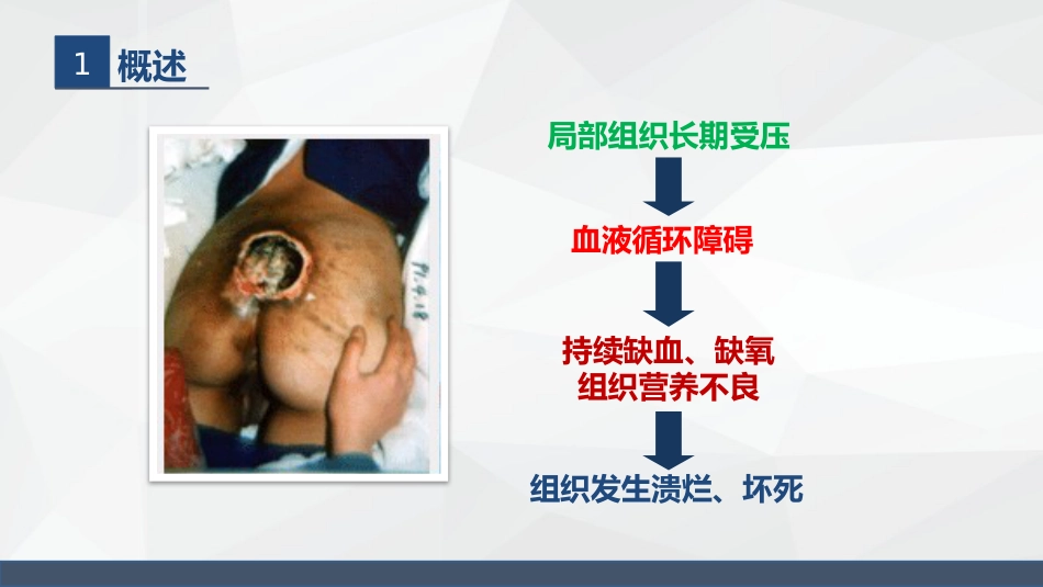 压疮的护理_第5页
