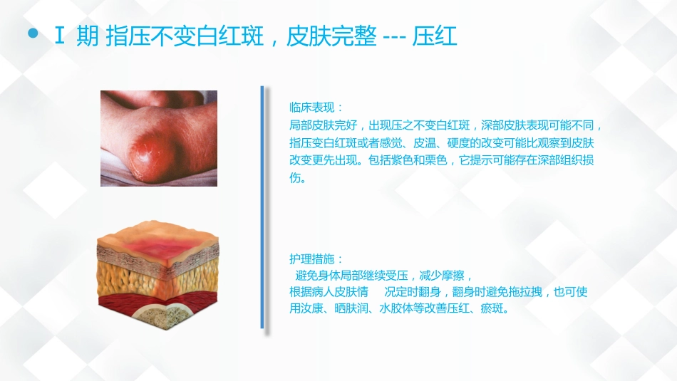 压疮的预防及护理_第12页