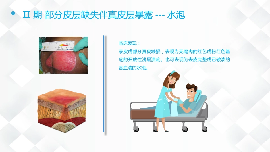 压疮的预防及护理_第13页