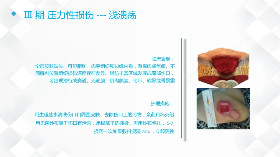 压疮的预防及护理_第15页
