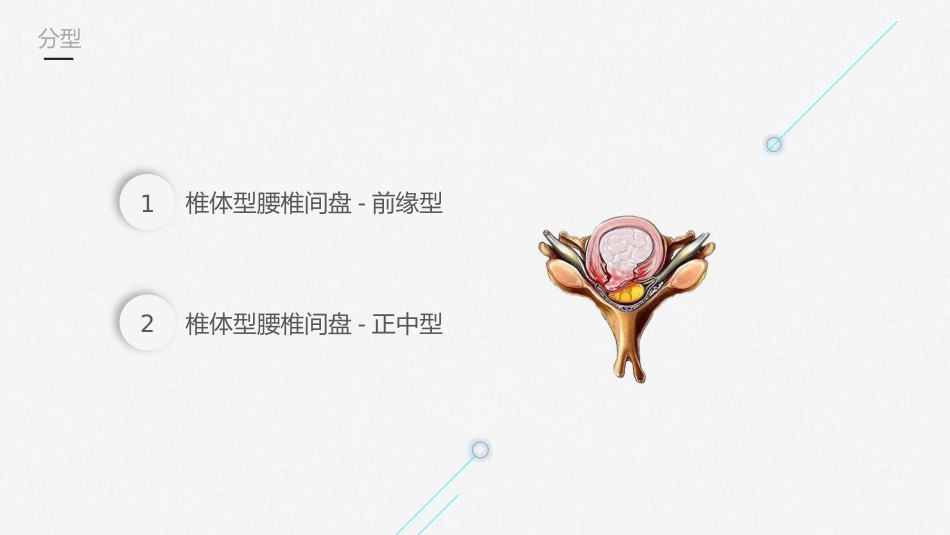 腰椎间盘突出症护理查房-模板参考_第6页