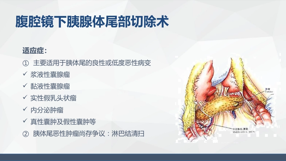 腹腔镜胰体尾手术护理配合_第5页