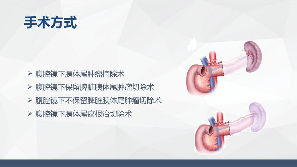 腹腔镜胰体尾手术护理配合_第7页