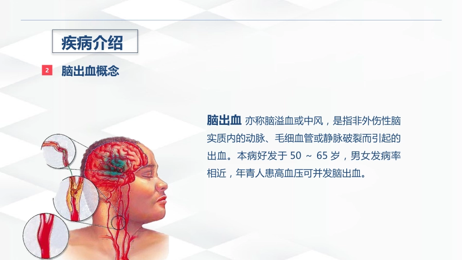 脑出血的术后护理_第5页