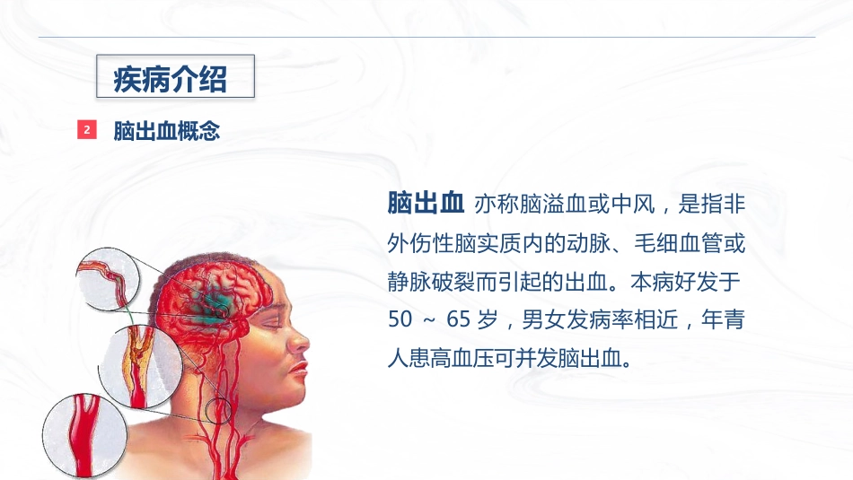 脑出血疾病介绍+术后护理_第5页