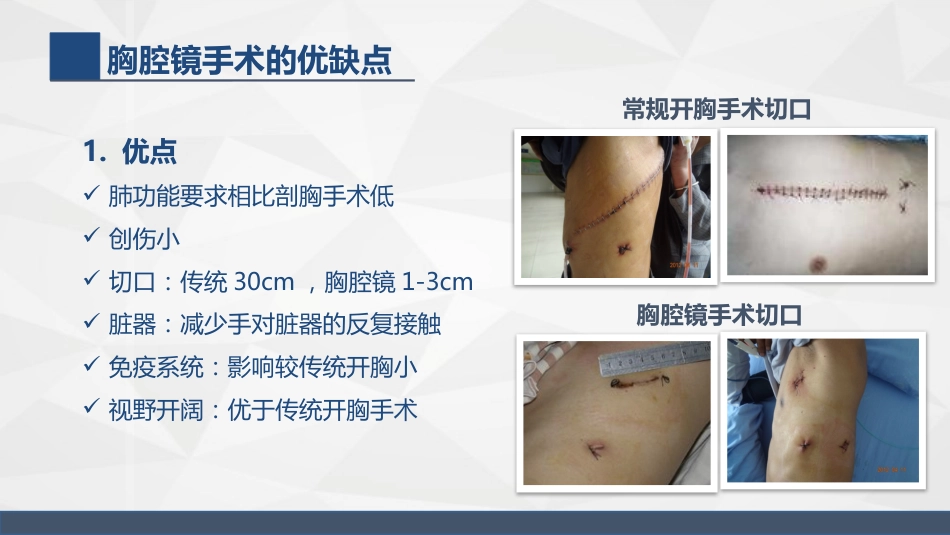 胸腔镜在胸外科的临床应用_第6页