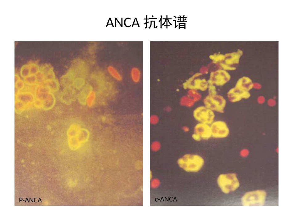 anca相关血管炎诊治进展_第9页