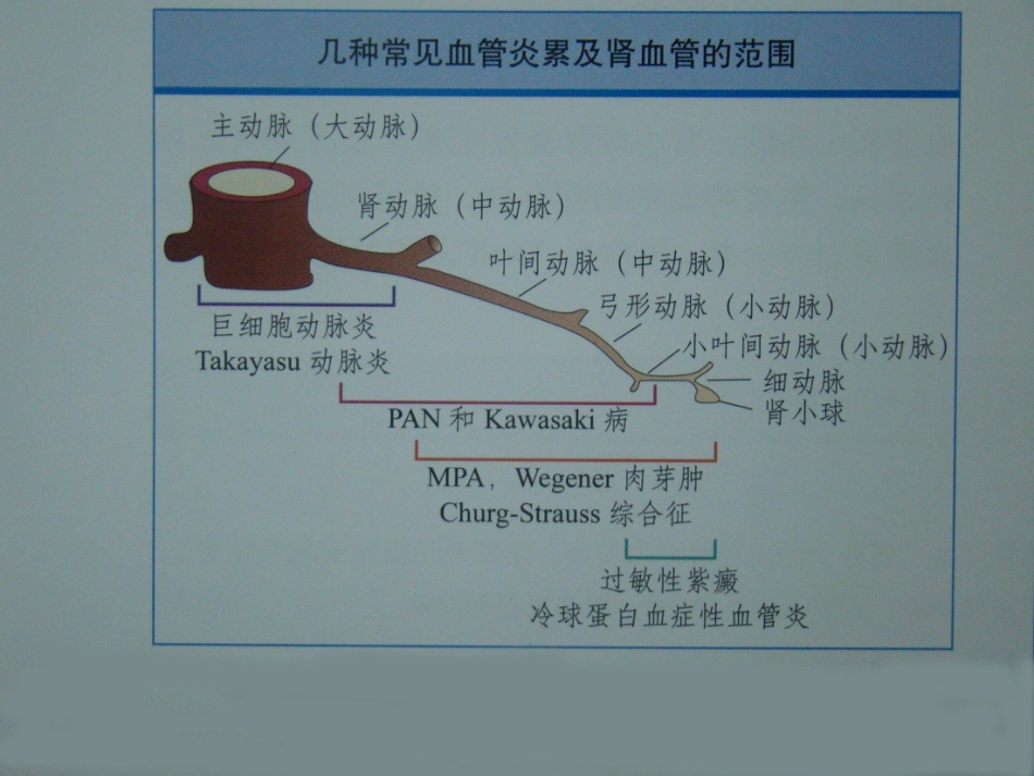 ANCA相关性血管炎诊疗进展_第4页