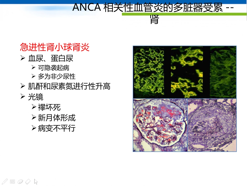 ANCA相关性血管炎诊断思路_第11页