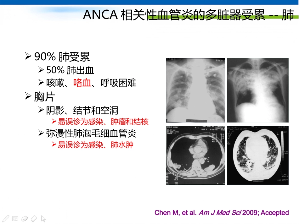 ANCA相关性血管炎诊断思路_第12页