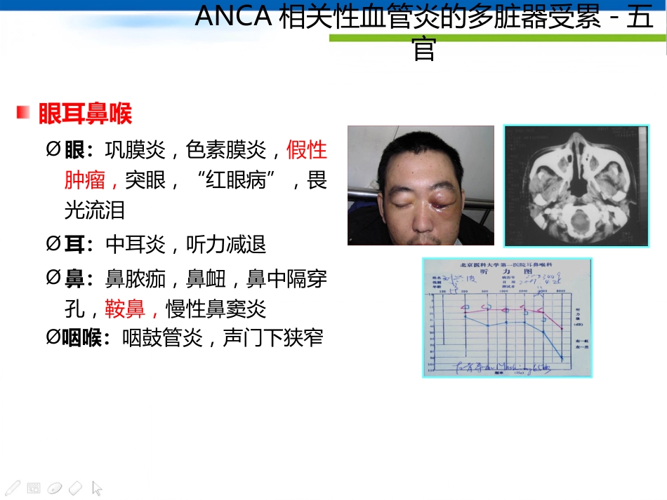 ANCA相关性血管炎诊断思路_第14页