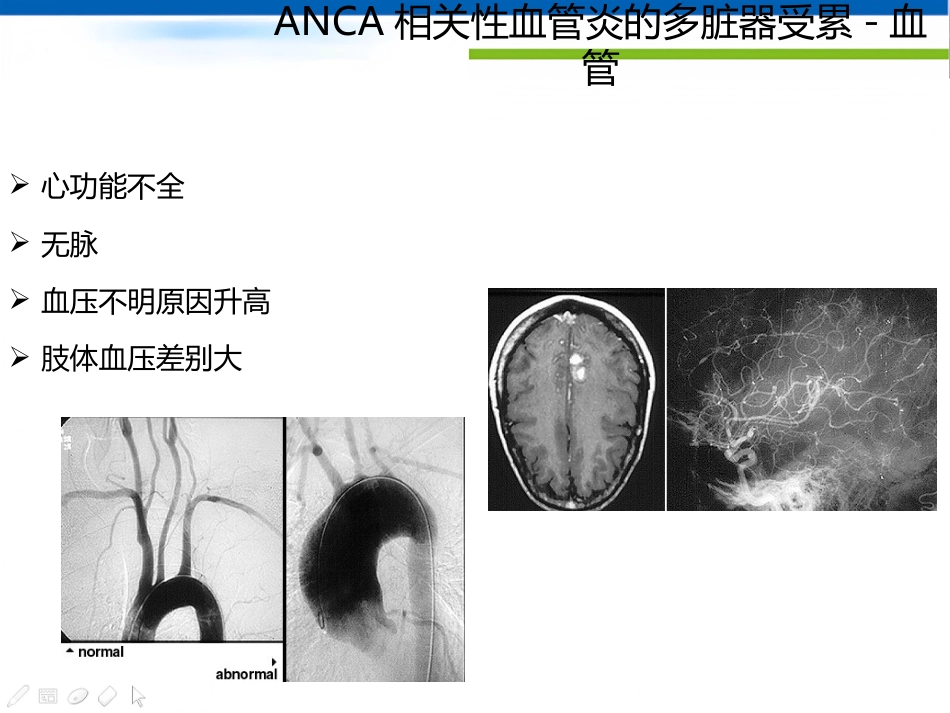ANCA相关性血管炎诊断思路_第15页