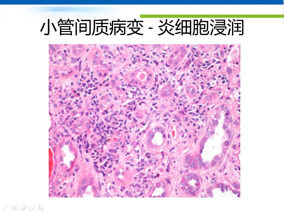 ANCA相关性血管炎肾损害病理表现_第10页