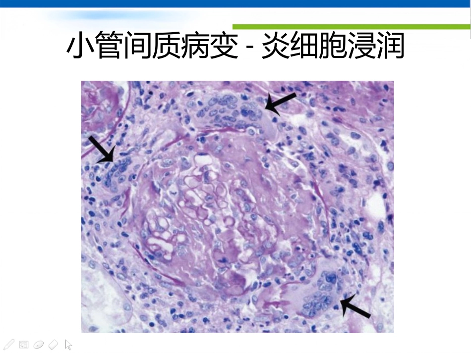 ANCA相关性血管炎肾损害病理表现_第11页