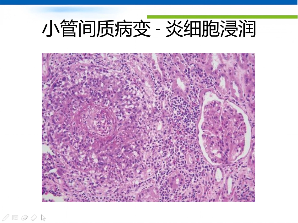ANCA相关性血管炎肾损害病理表现_第12页