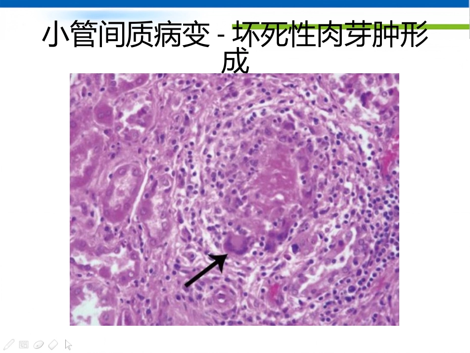 ANCA相关性血管炎肾损害病理表现_第13页