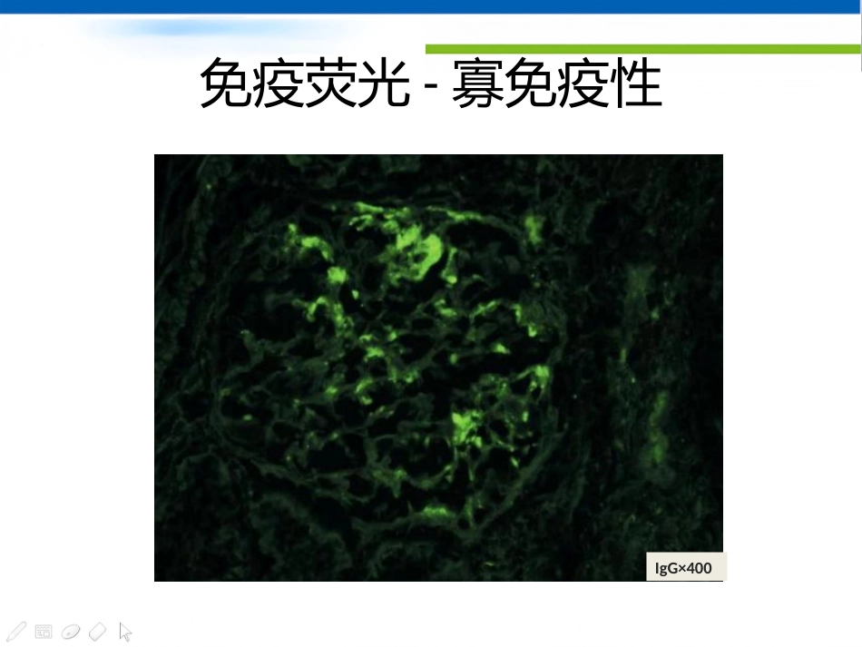 ANCA相关性血管炎肾损害病理表现_第14页
