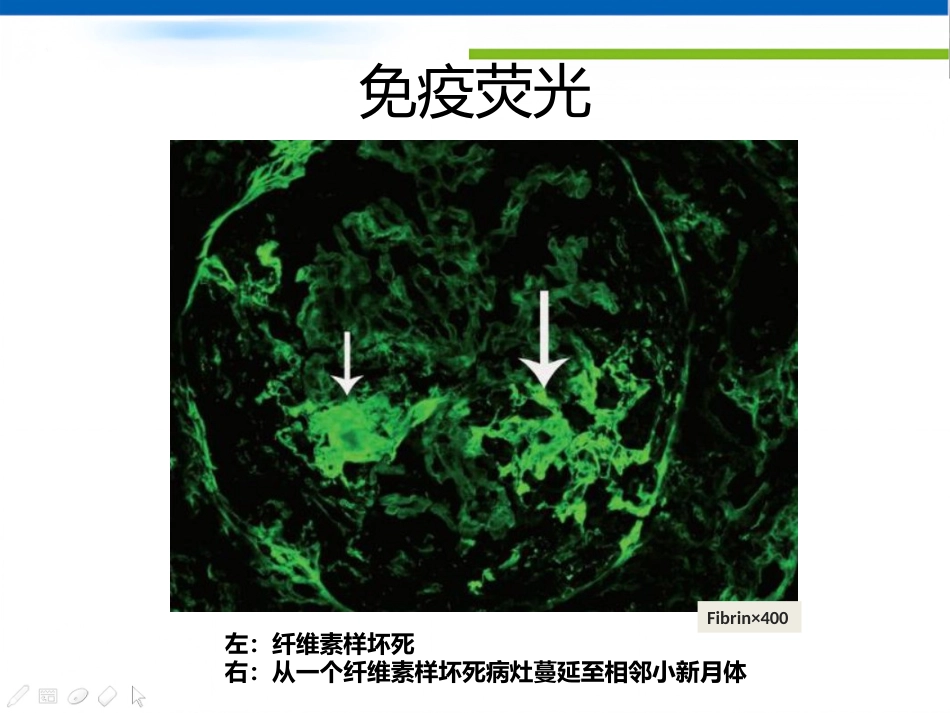 ANCA相关性血管炎肾损害病理表现_第15页