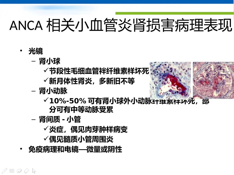 ANCA相关性血管炎肾损害病理表现_第4页