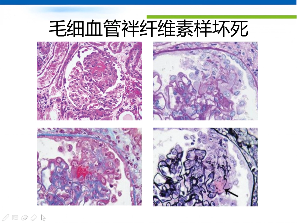 ANCA相关性血管炎肾损害病理表现_第5页