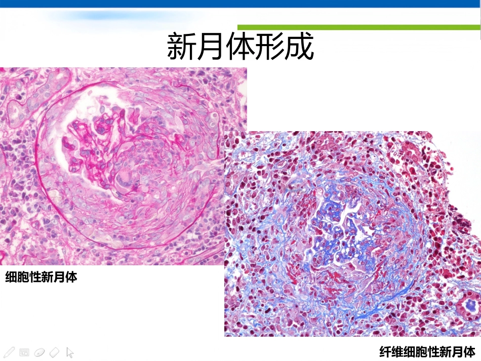 ANCA相关性血管炎肾损害病理表现_第6页